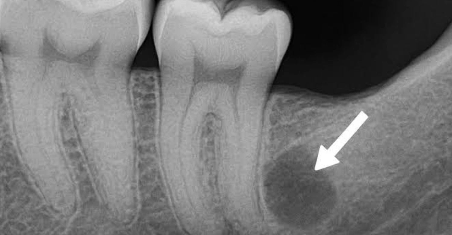 Type of Dental Abscess Inblog